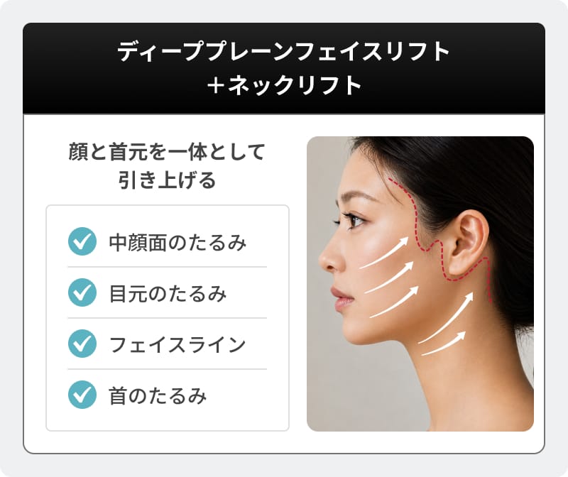 ネックリフトとの組み合わせにより若々しいフェイスラインを形成
