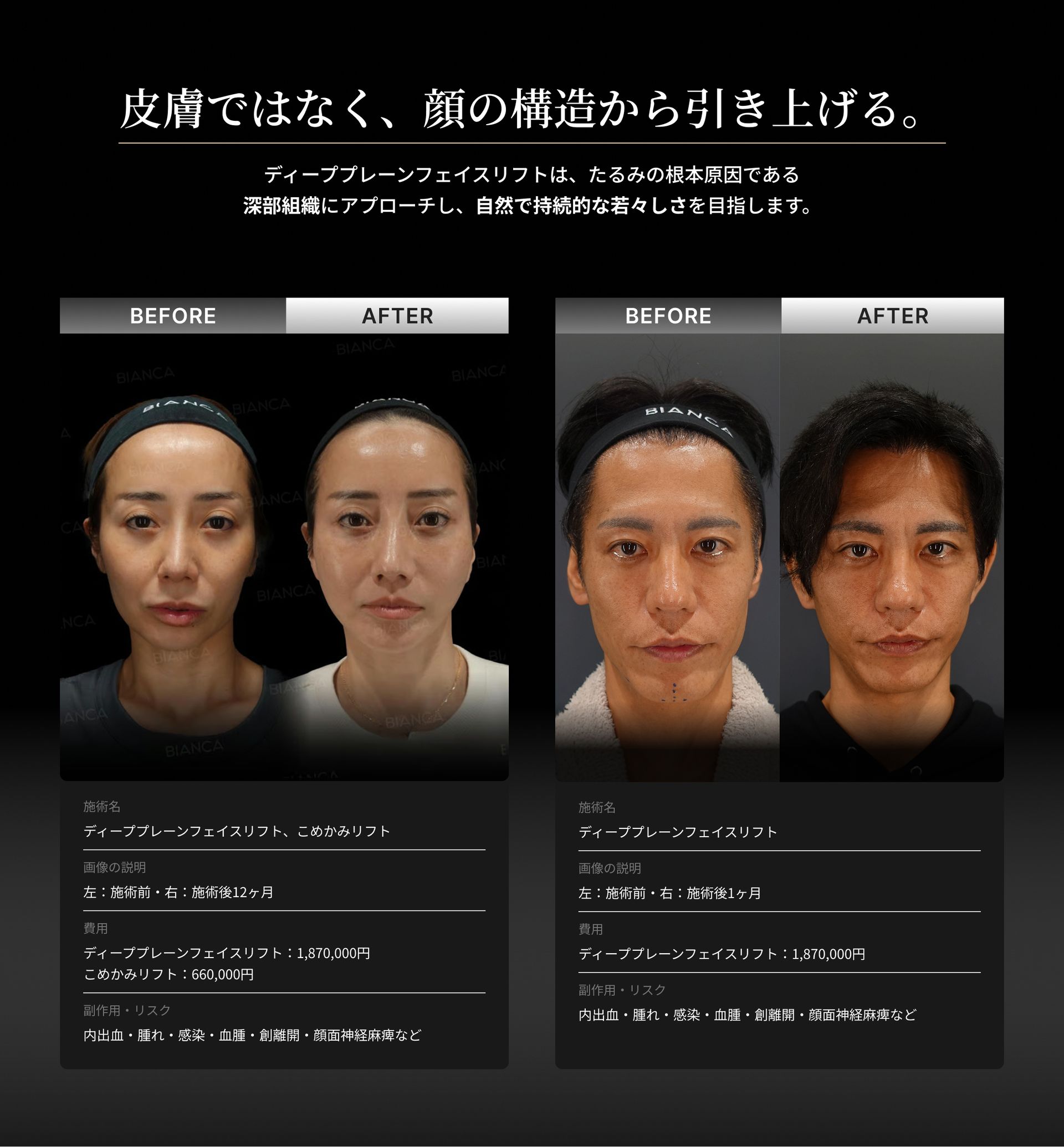 ディーププレーンフェイスリフトの仕組みと症例を紹介した図