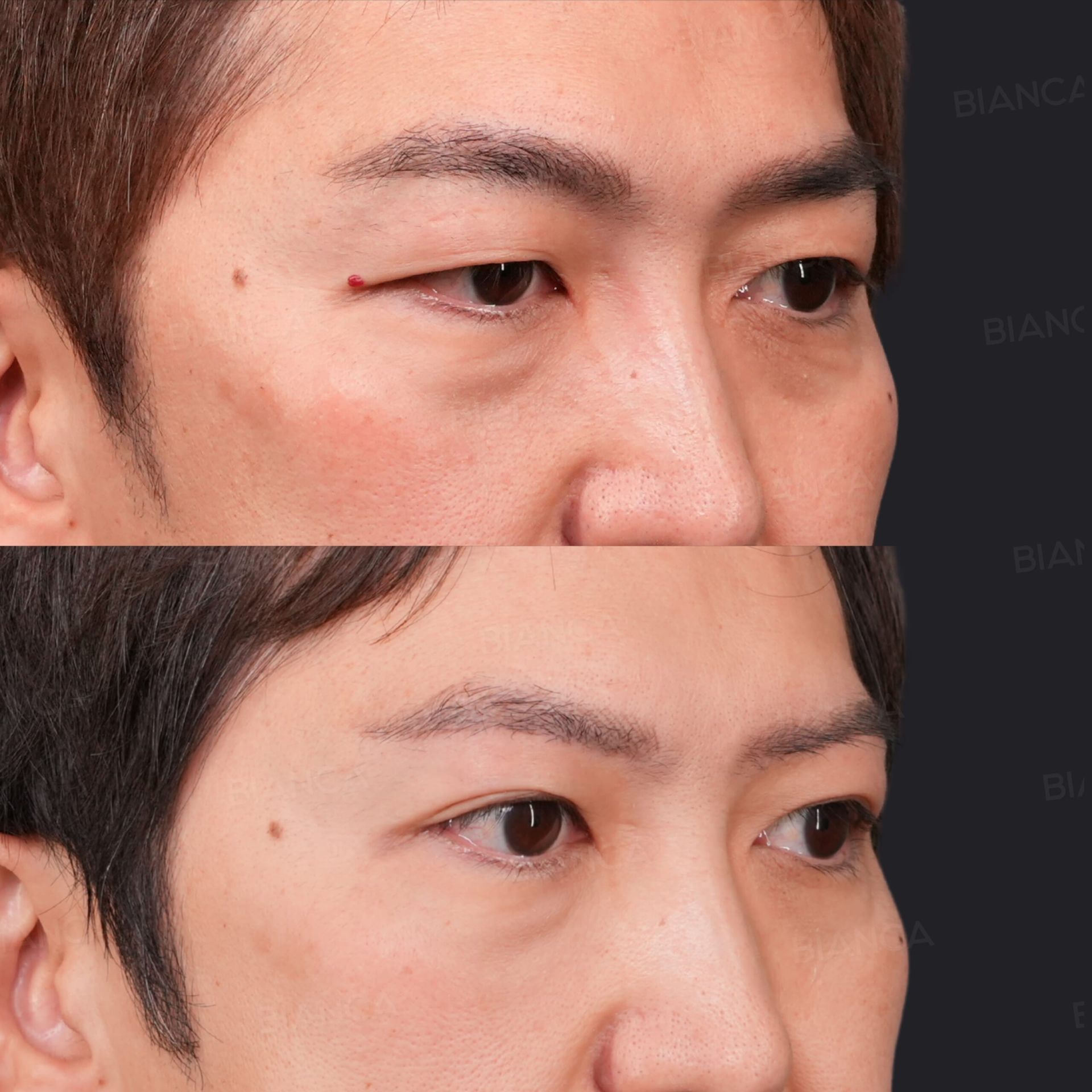 眉下切開、二重埋没(自然癒着法)