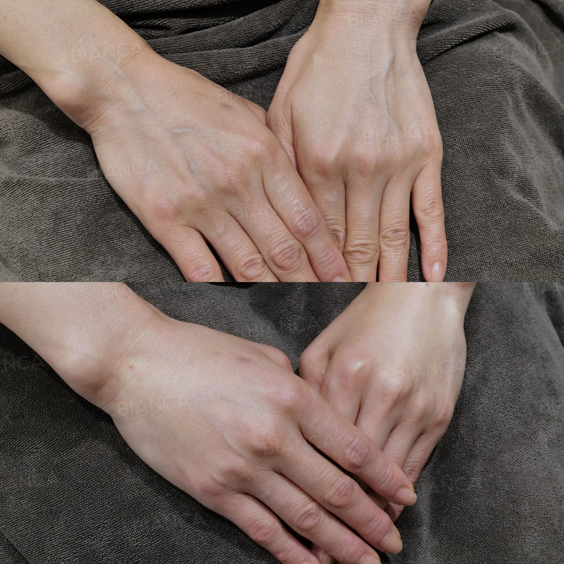 GOURI(手の甲)