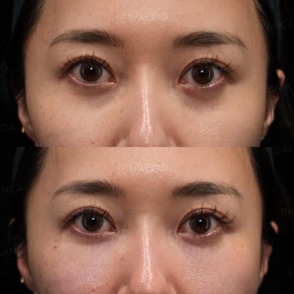 ezGEL(PRF)|銀座・表参道にあるBIANCA CLINIC ビアンカクリニック|美容外科・美容皮膚科・再生医療・美容婦人科・美容内科・医療アートメイク