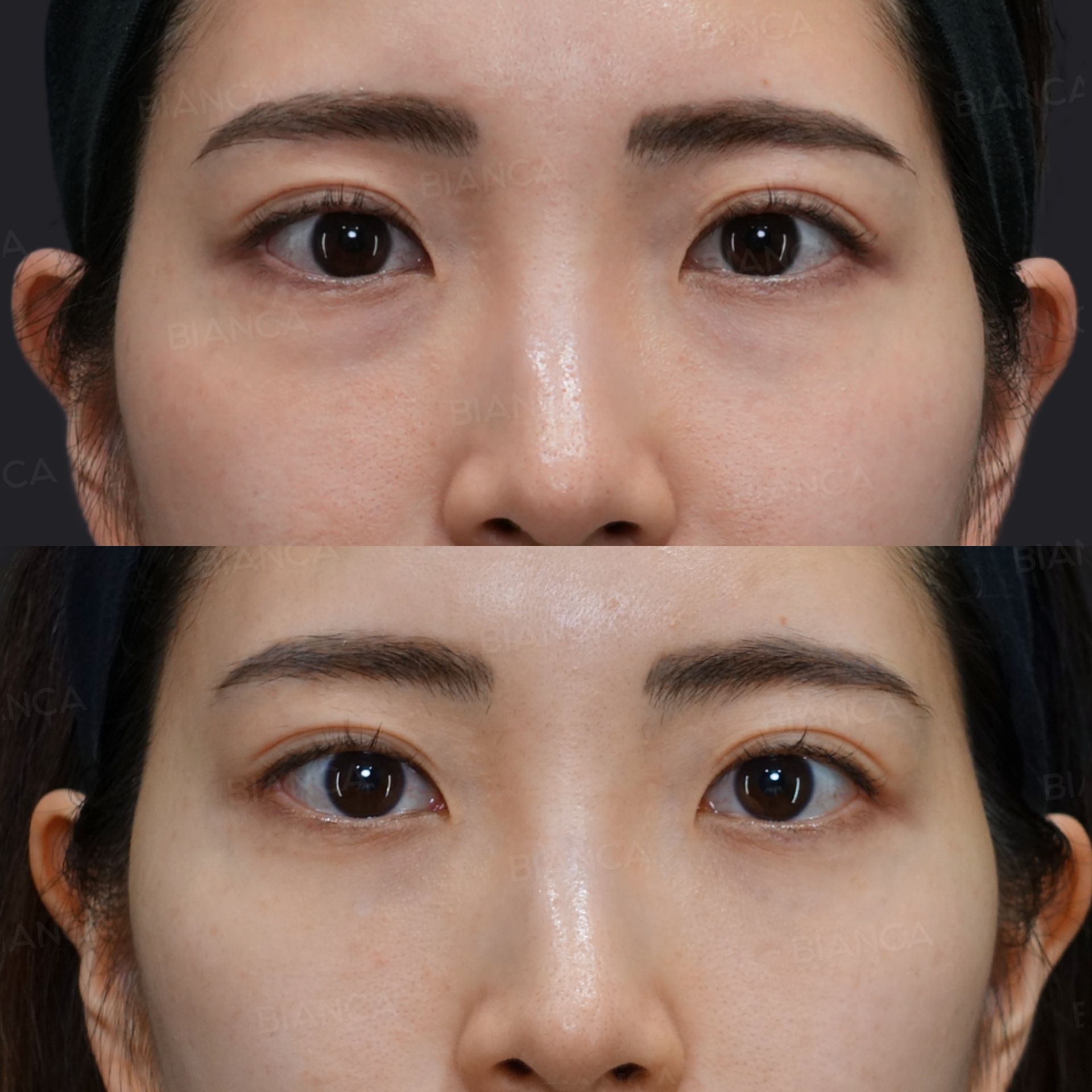 目の下のクマ・たるみ取り(経結膜脱脂術)