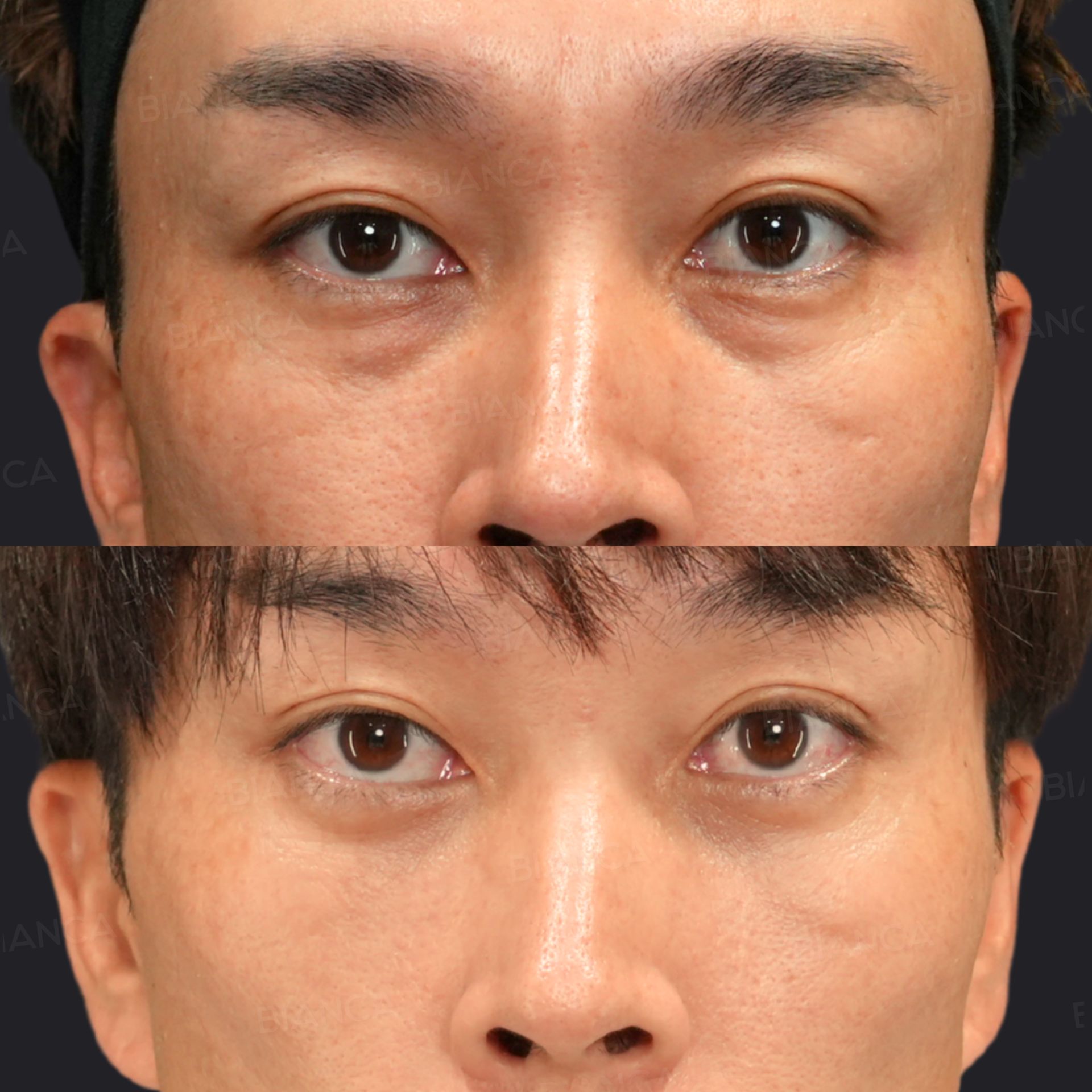 目の下のクマ・たるみ取り(経結膜脱脂術)