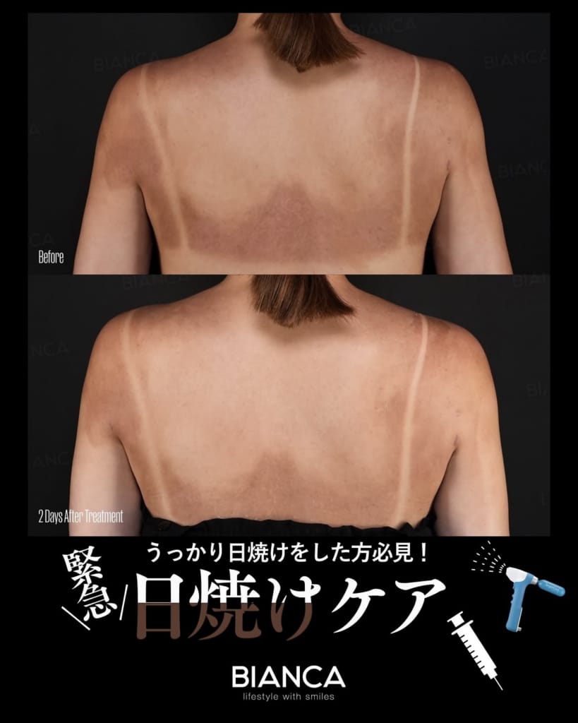 💎 トラネキサム酸で日焼け後ケア