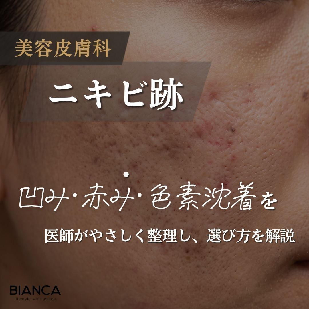 美容皮膚科ニキビ跡｜凹み・赤み・色素沈着を医師がやさしく整理し、選び方を解説