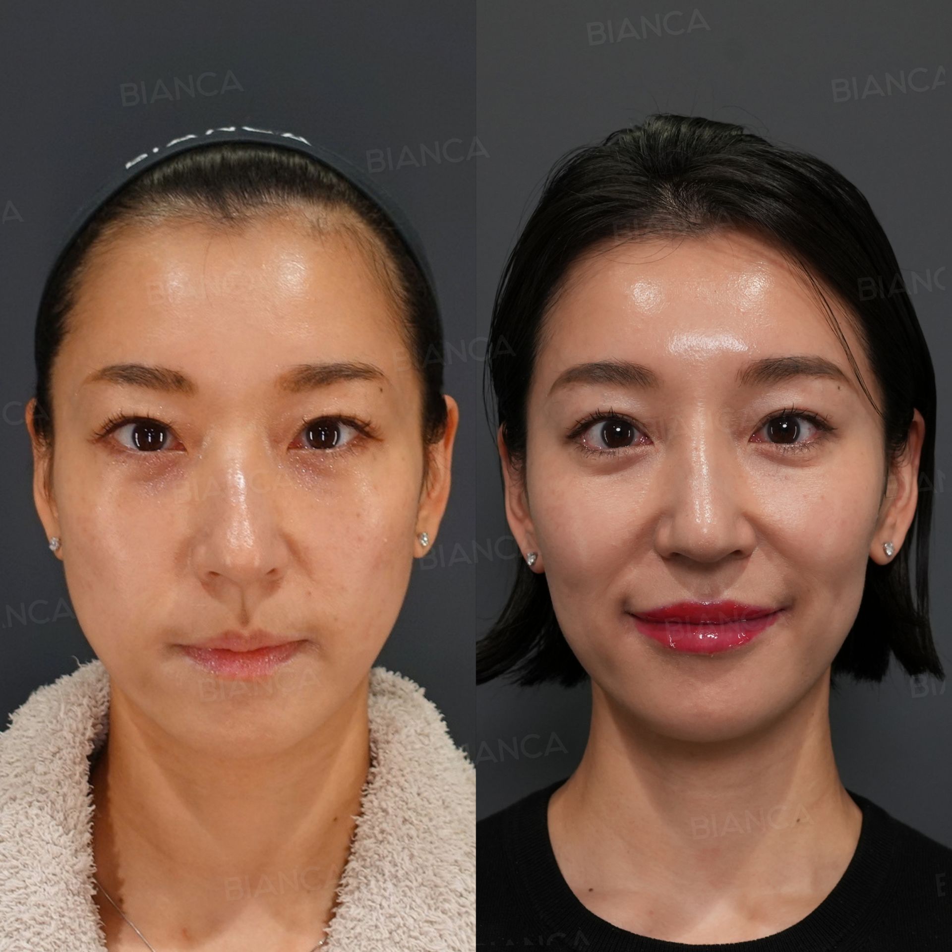 バッカルファット、グラマラスライン形成、ナノステム、アートメイク(眉)、BIANCALIFT、二重埋没法、ヒアルロン酸注射、ボトックス注射、脂肪注入、肌施術