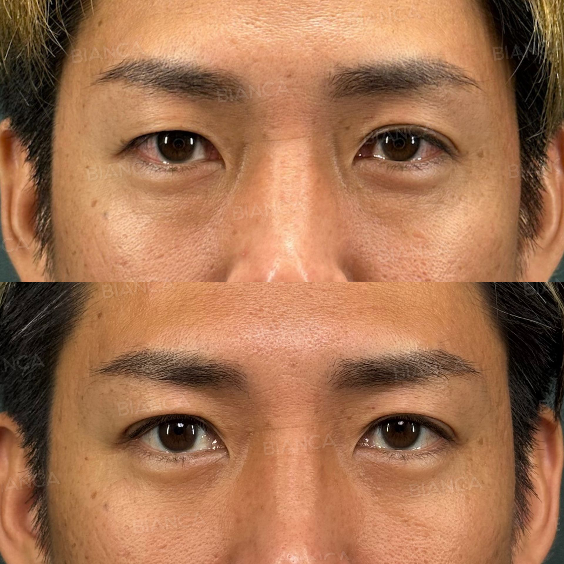 目の下クマ・たるみ取り、二重埋没(自然癒着法)