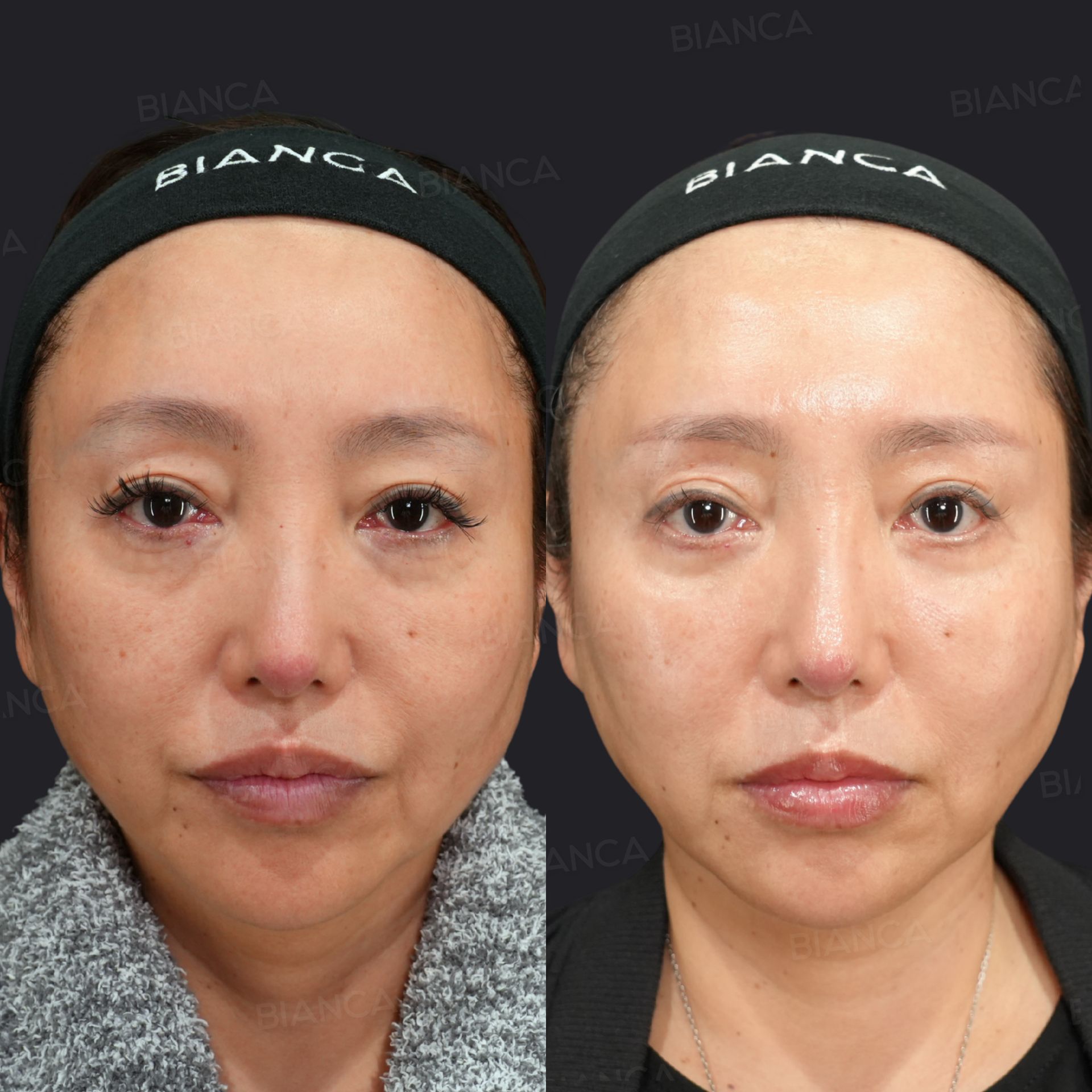眉下切開、ハムラ法