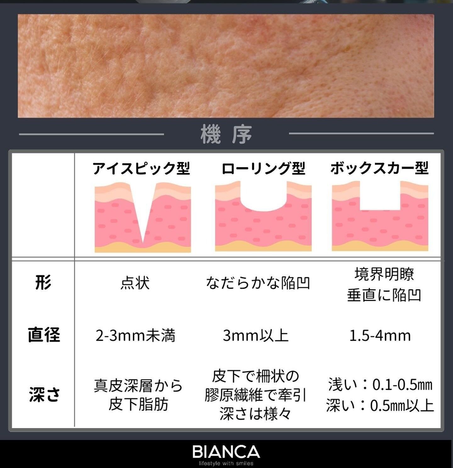 Types of atrophic acne scars, including ice pick, boxcar, and rolling scars