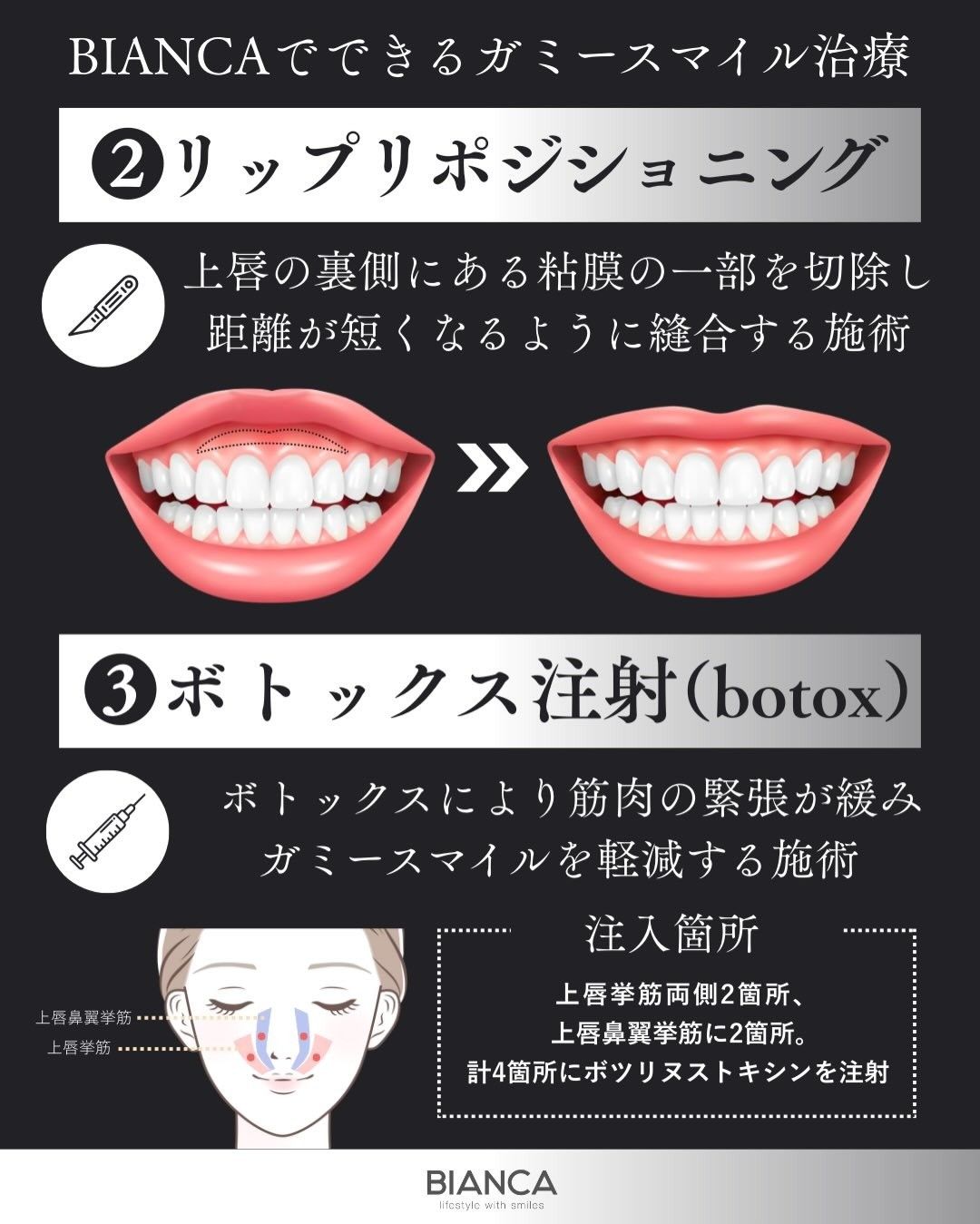 リップリポジショニングとは上唇の裏側にある粘膜の一部を切除し距離が短くなるように縫合する施術であることを説明する画像