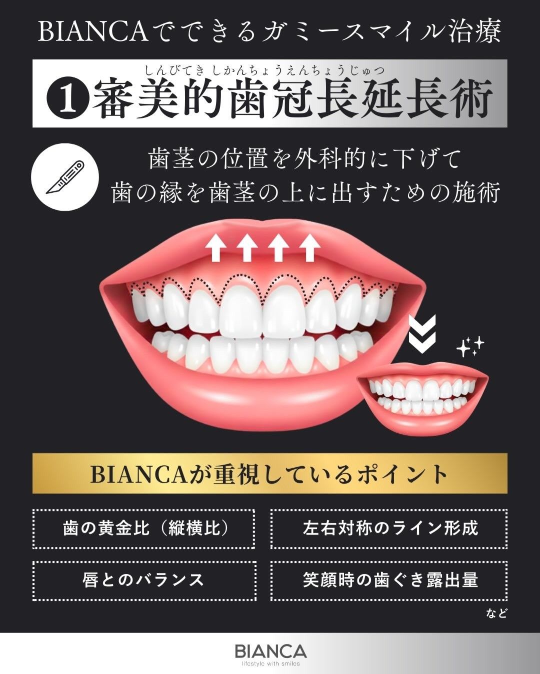 審美的歯冠長延長術とは歯茎の位置を外科的に下げ葉のふちを歯茎の上に出す施術であることを説明する画像