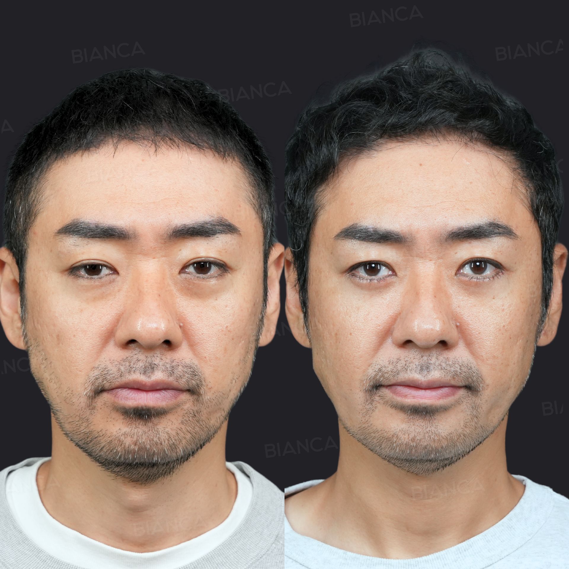 ハムラ法