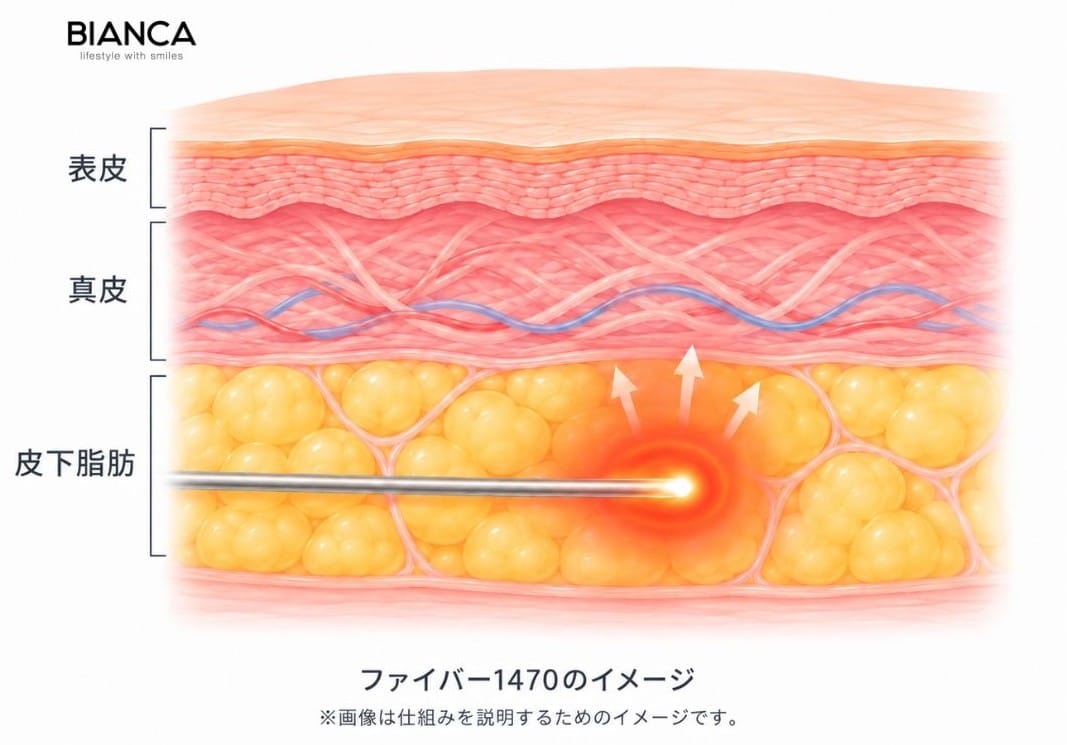 ファイバー1470の皮内での操作の様子を示すイメージ画像
