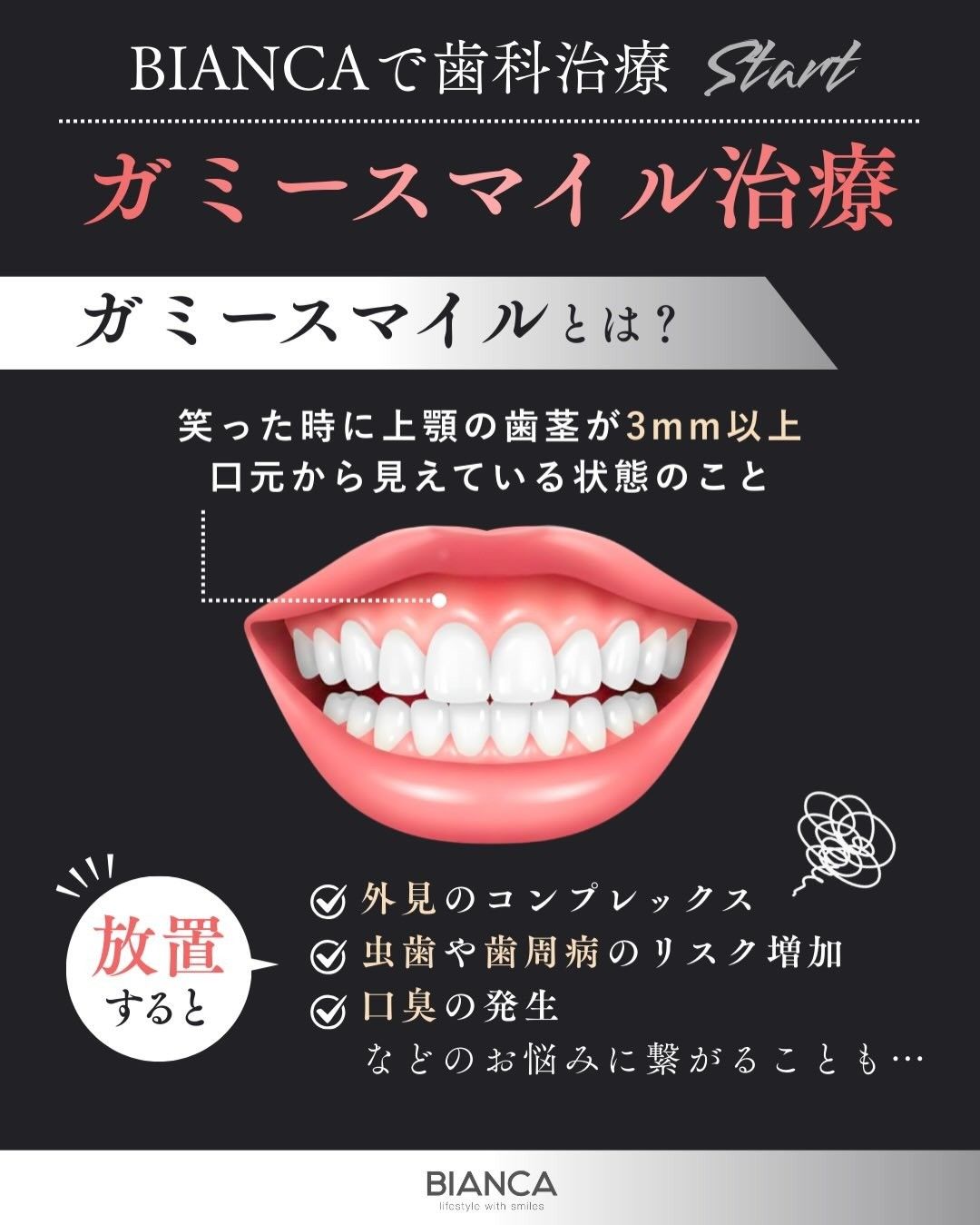 ガミースマイルとは笑ったときに上顎の歯茎が３㎜以上口元から見えている状態のことを説明した画像