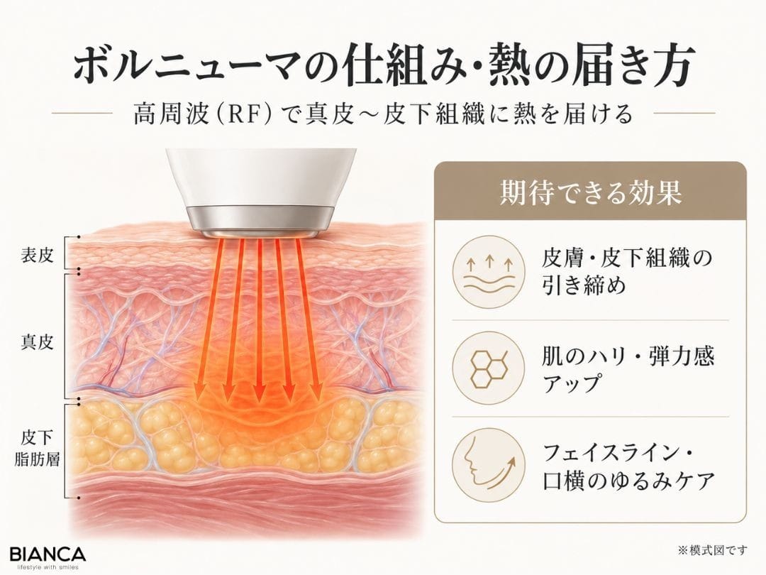 ボルニューマの高周波（RF）が真皮から皮下脂肪層に熱を届ける仕組みと、皮膚の引き締め・肌のハリ・フェイスラインへの効果を示した模式図