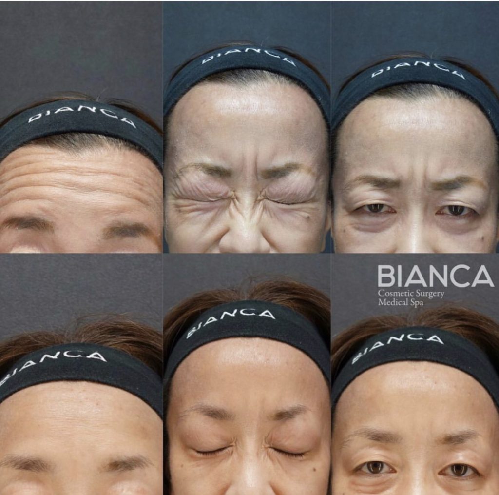 女優ボトックス🩰