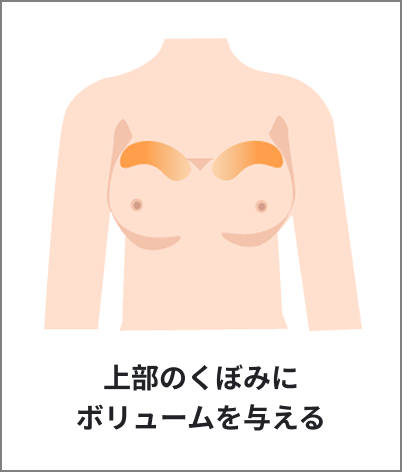 上部のくぼみにボリュームを与える