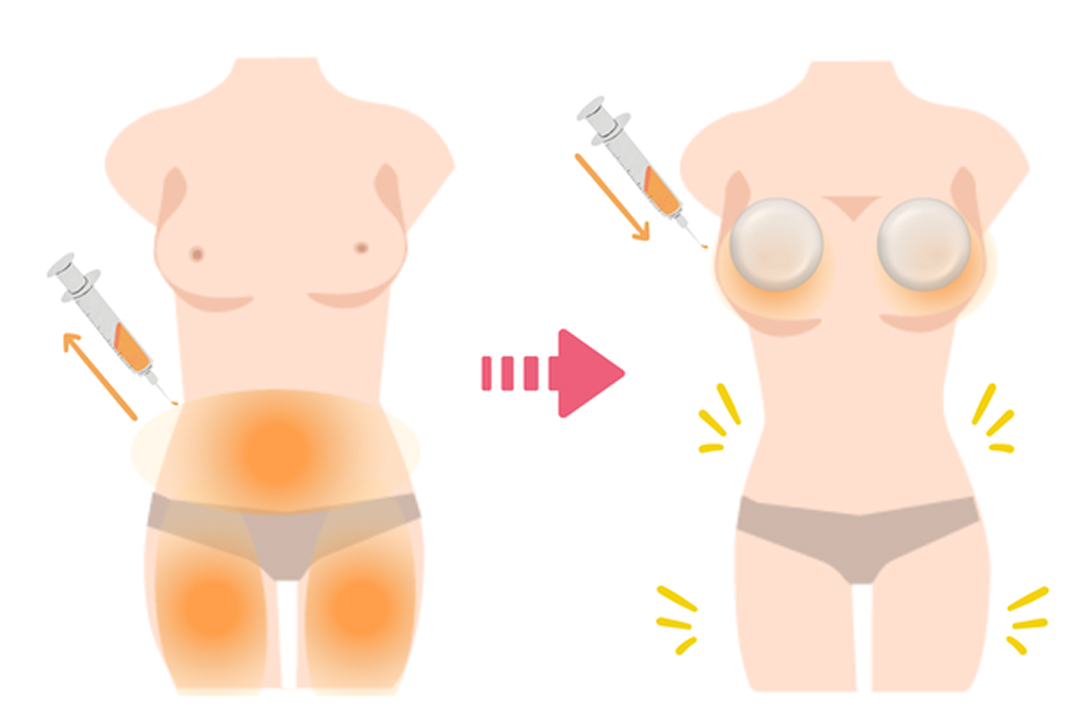 ハイブリッド豊胸（シリコンバッグ+コンデンスリッチ）