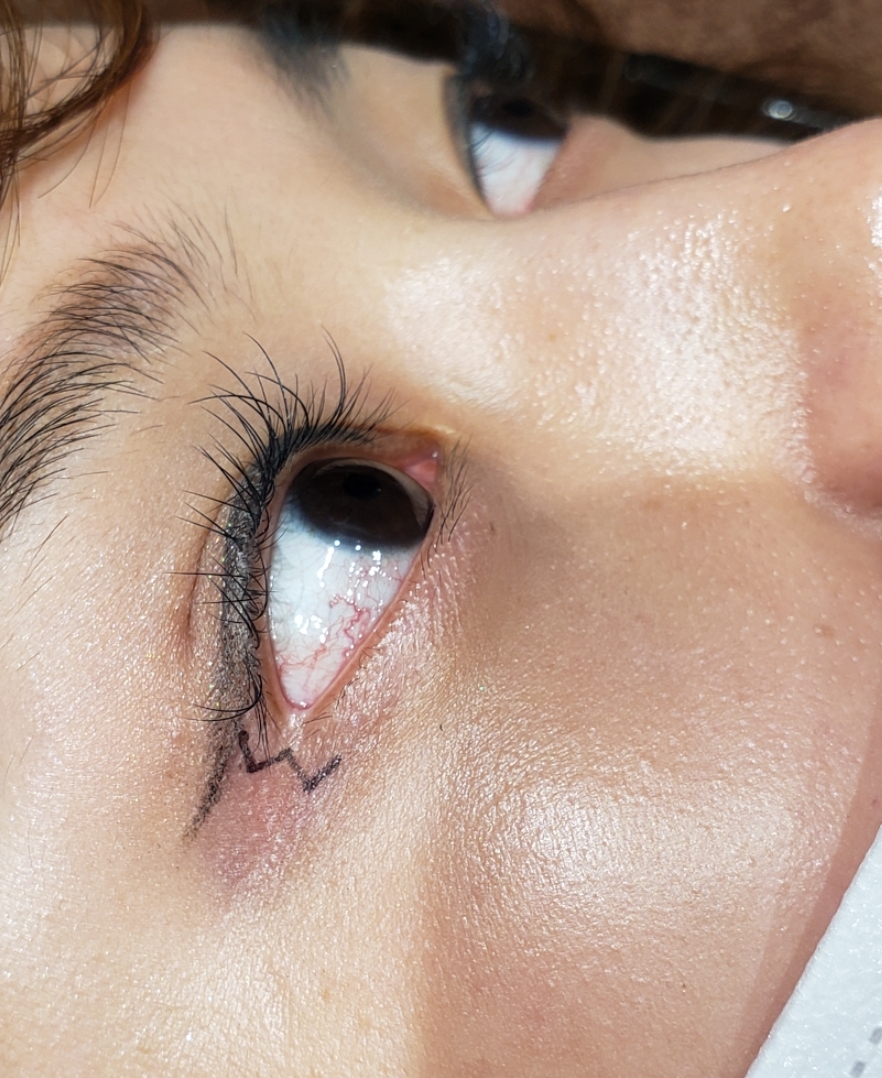 目尻切開👁️