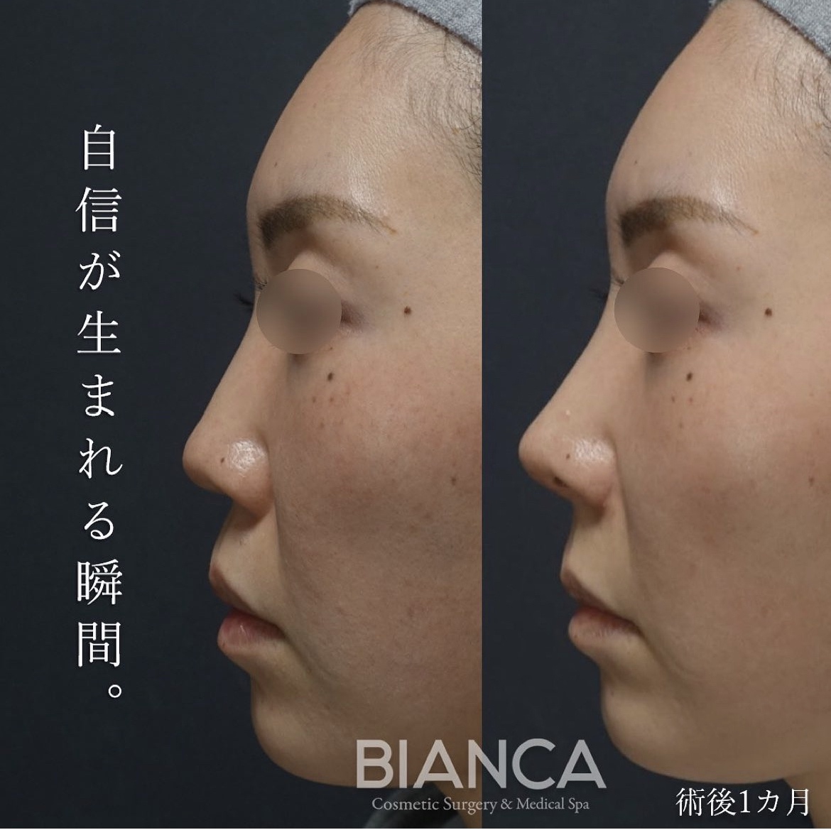 鼻翼 鼻翼縮小（小鼻縮小） | 日本を代表する美容健康再生医療のクリニック｜BIANCAGINZA