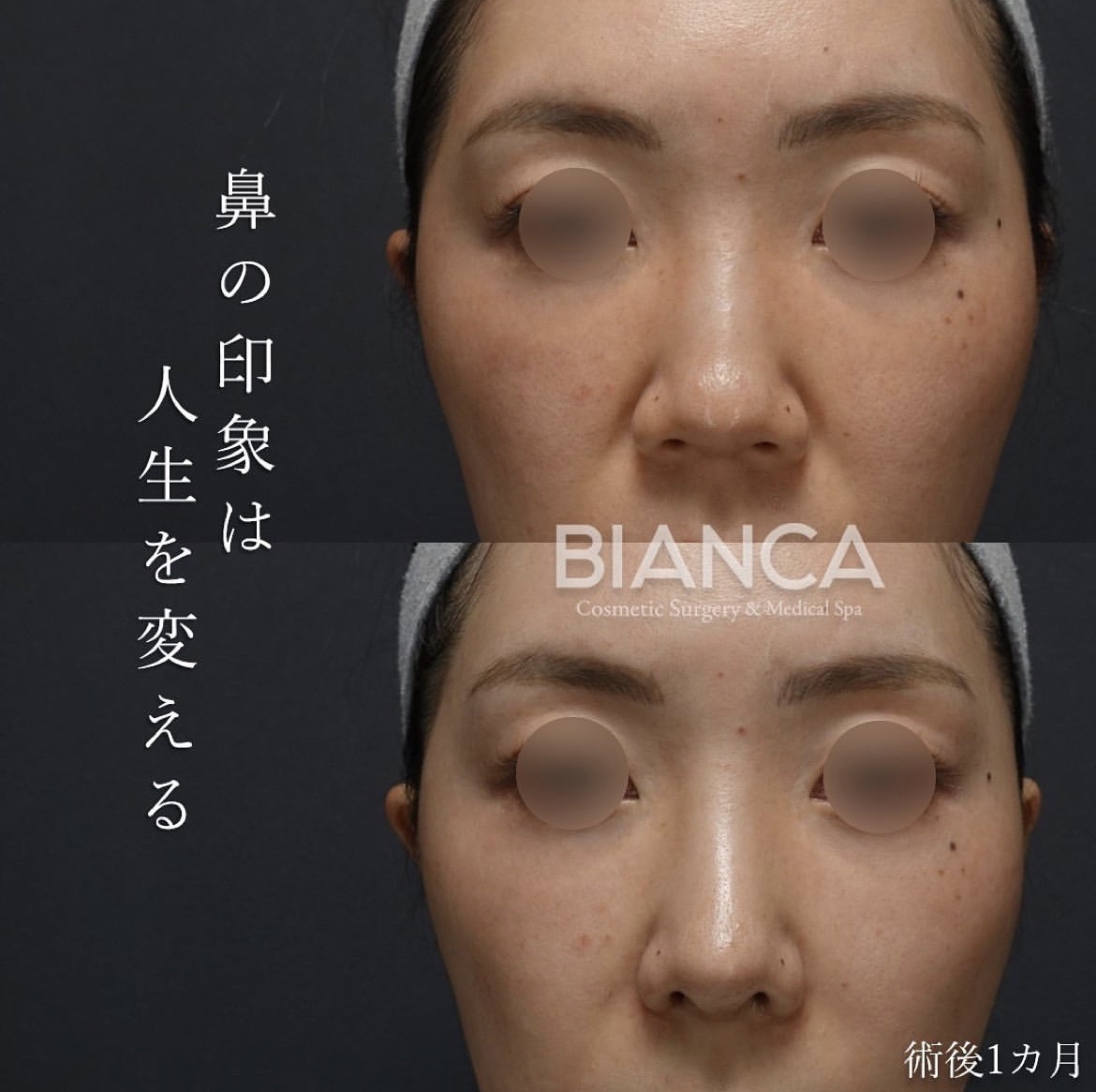 鼻翼 鼻翼縮小（小鼻縮小） | 日本を代表する美容健康再生医療のクリニック｜BIANCAGINZA