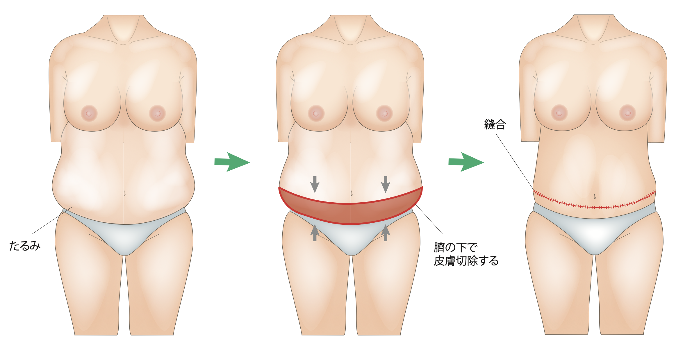 Tummy tuck (abdominal resection/umbilical formation), Japan's leading  beauty, health and regenerative medicine clinic