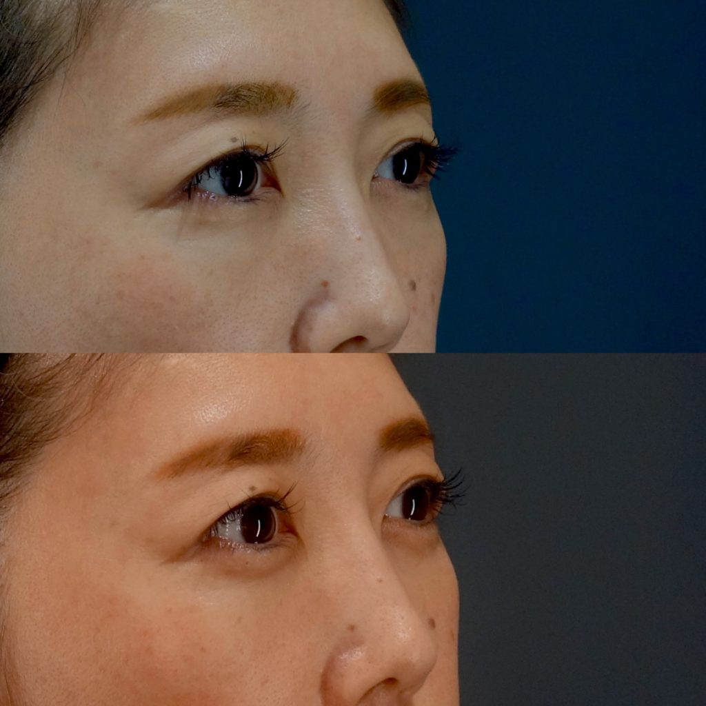 What To Do If Degreaser In Eye at Kyle Harris blog