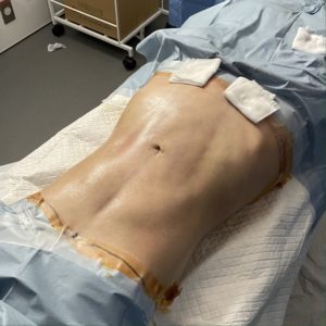 脂肪吸引の手術直後