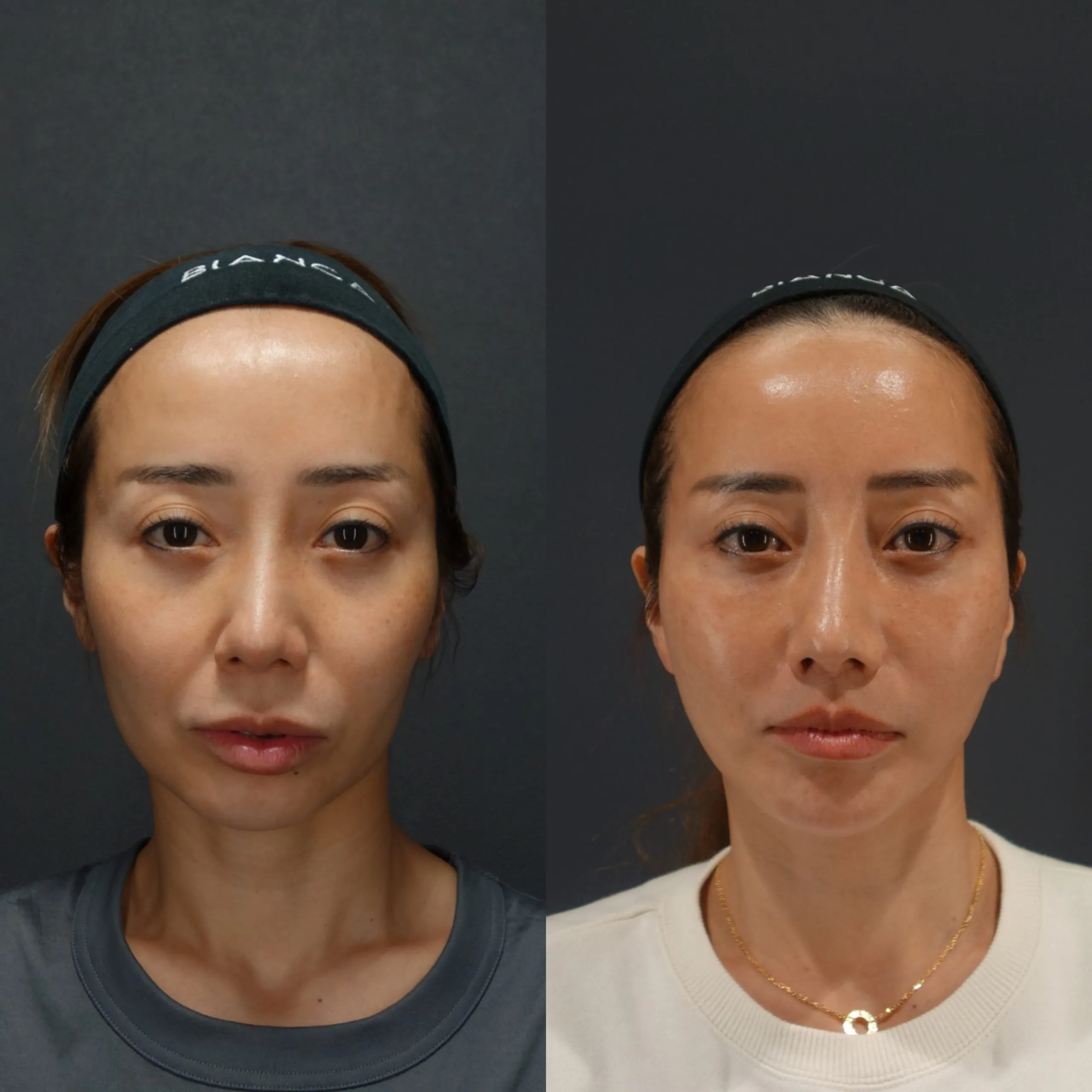 ディープ プレーン フェイスリフト + こめかみリフト 日本を代表する美容健康再生医療のクリニック｜ビアンカ銀座